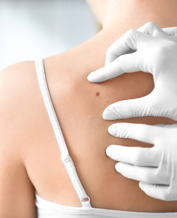 Malignant Skin Tumor Removal