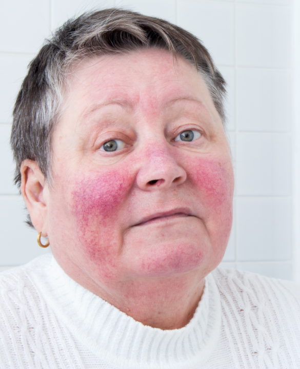 Rosacea