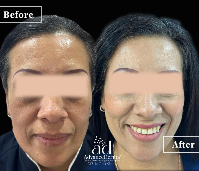 Hyaluronic Acid 2