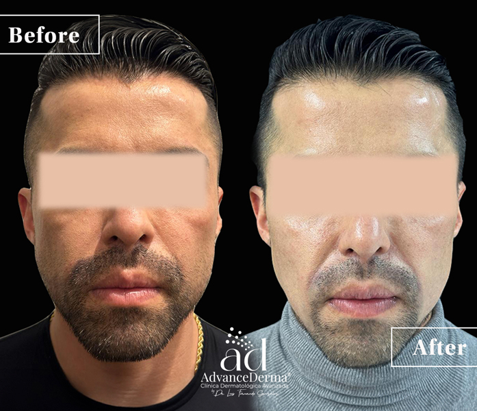 Hyaluronic Acid 3