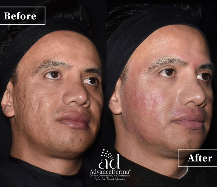 Scar Management 3