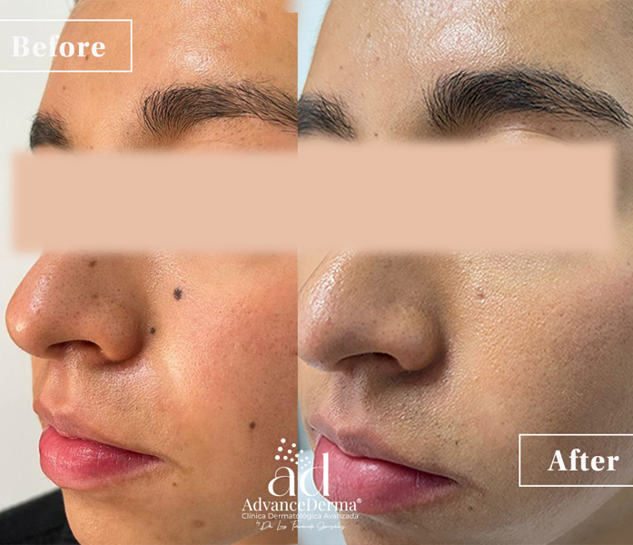 Moles Resection 1
