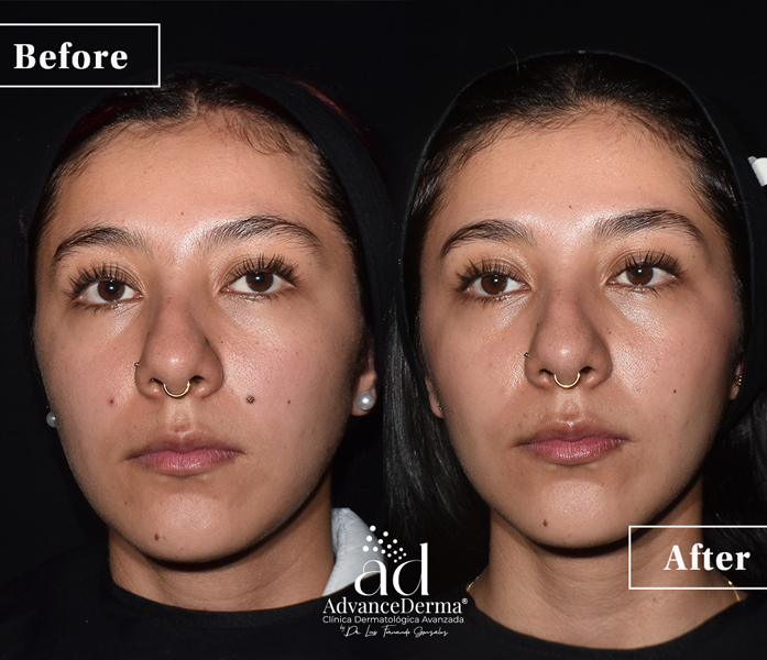 Moles Resection 2