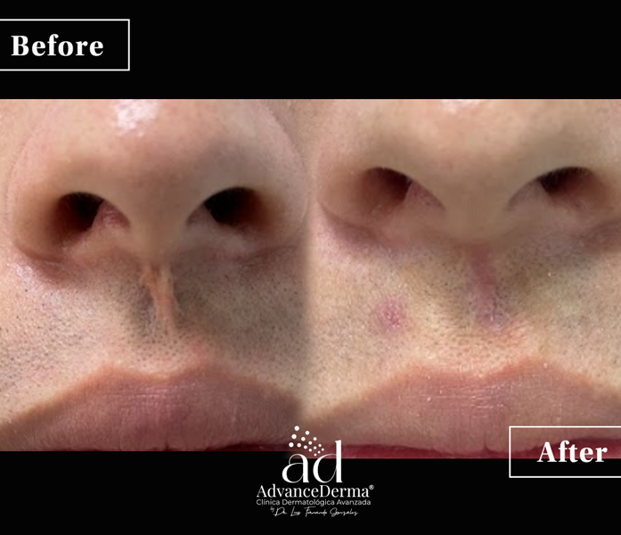 Keloid Resection 2