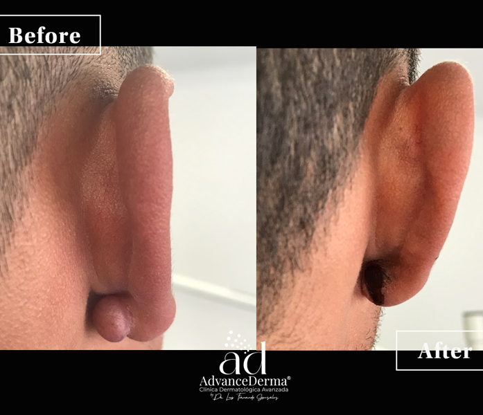 Keloid Resection 3