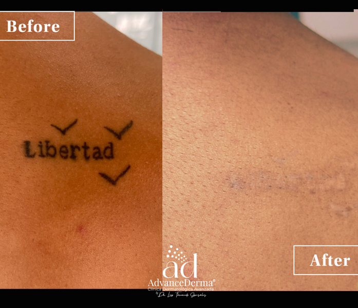 Tattoo Removal 1