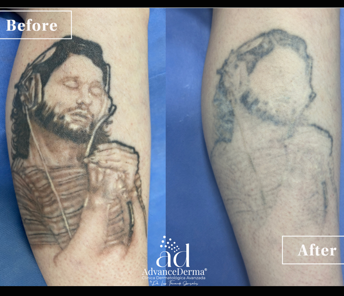 Tattoo Removal 2