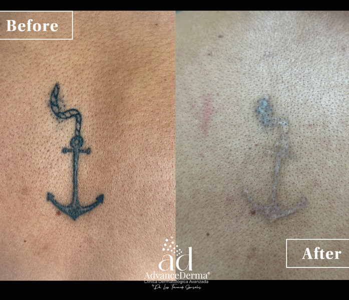 Tattoo Removal 3