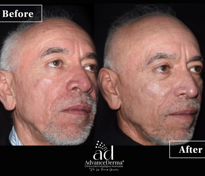 Rhinophyma 2
