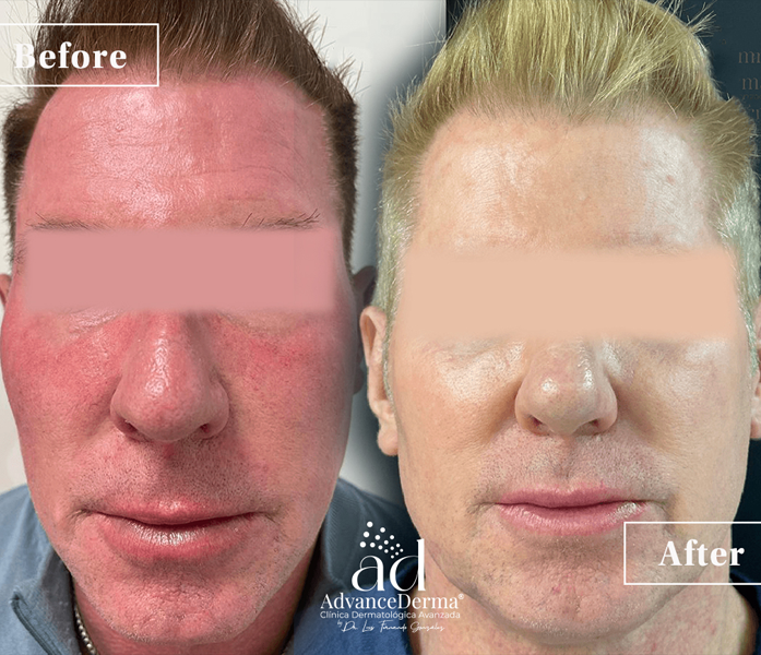Rosacea 1
