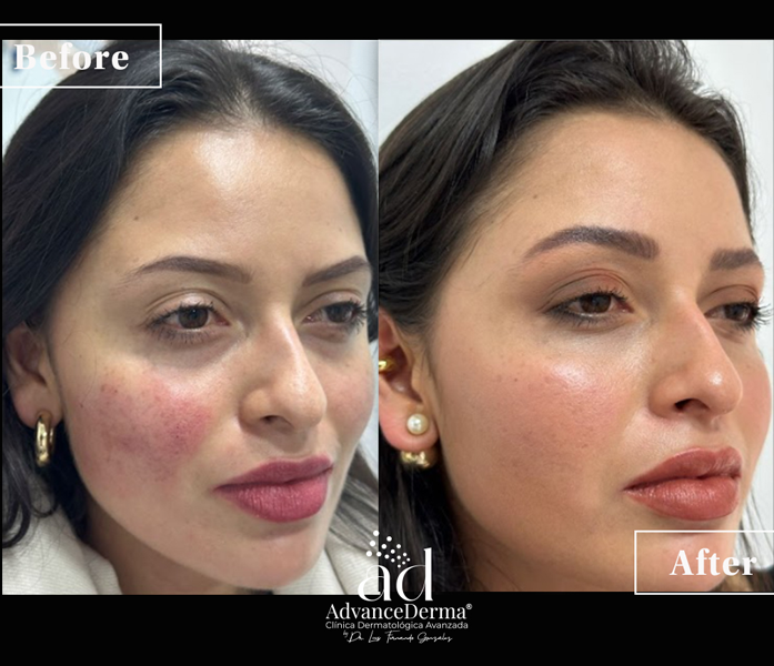 Rosacea 2