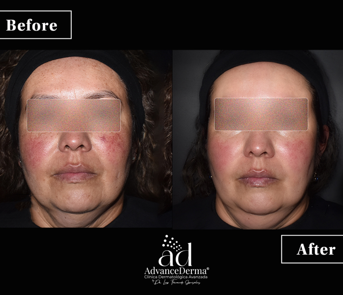 Rosacea 3