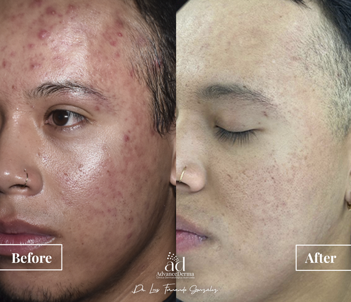 Acne Treatment 1