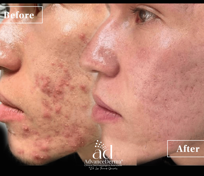 Acne Treatment 2