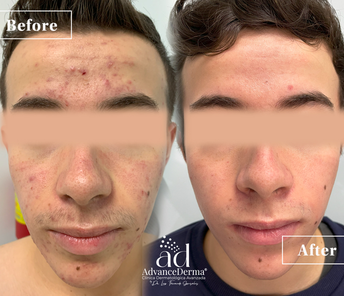 Acne Treatment 3