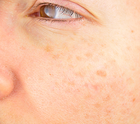 Skin Spots Causes Types and Treatments